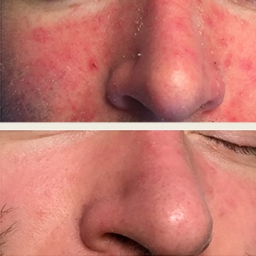 Behandling af Rosacea