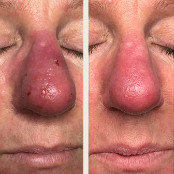 Behandling af Rosacea