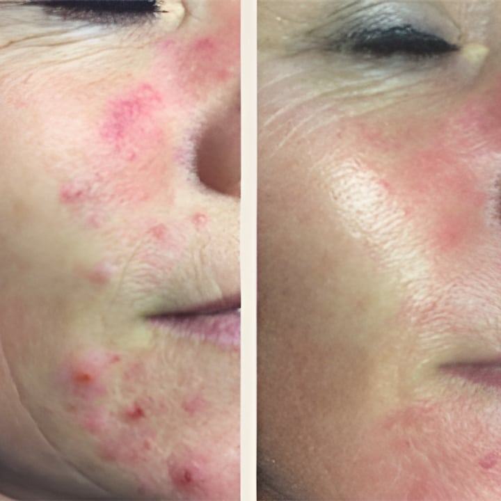 Behandling af Rosacea