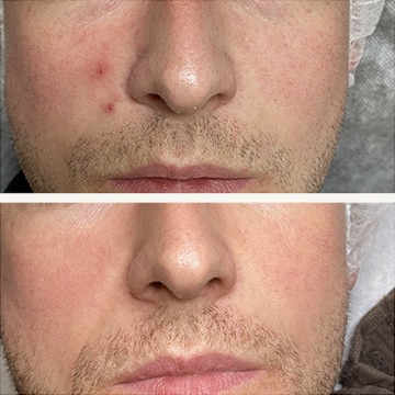 Behandling af Rosacea