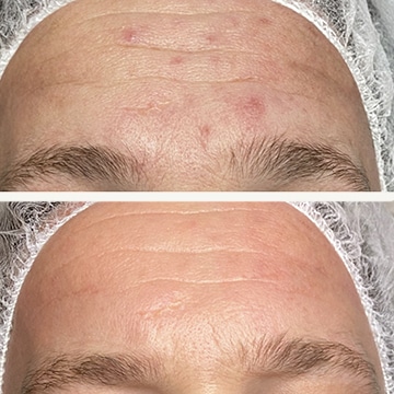 Behandling af Rosacea