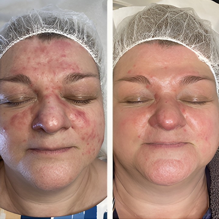 Behandling af Rosacea