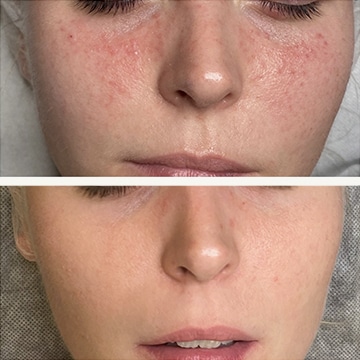 Behandling af Rosacea