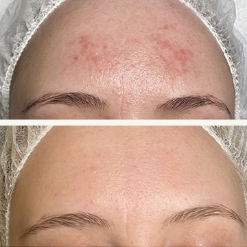 Behandling af Rosacea