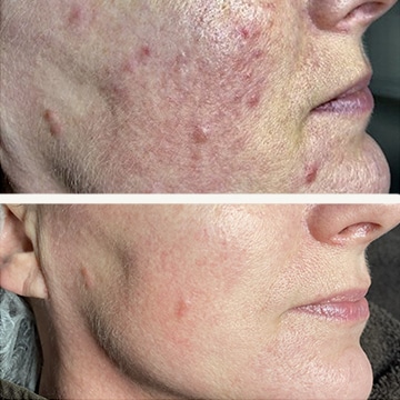 Behandling af Rosacea