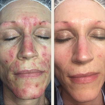 Behandling af Rosacea