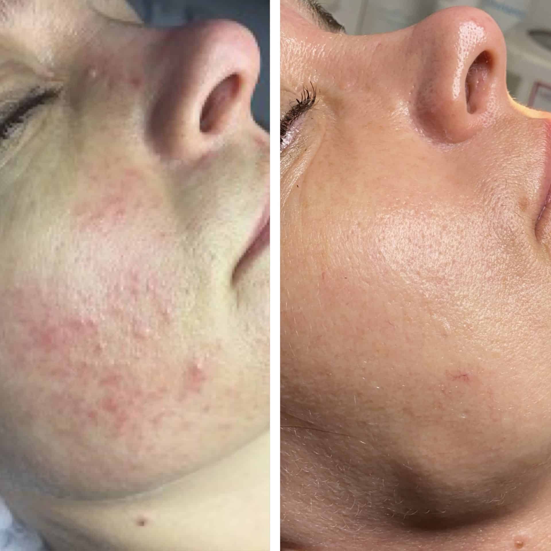 Behandling af Rosacea