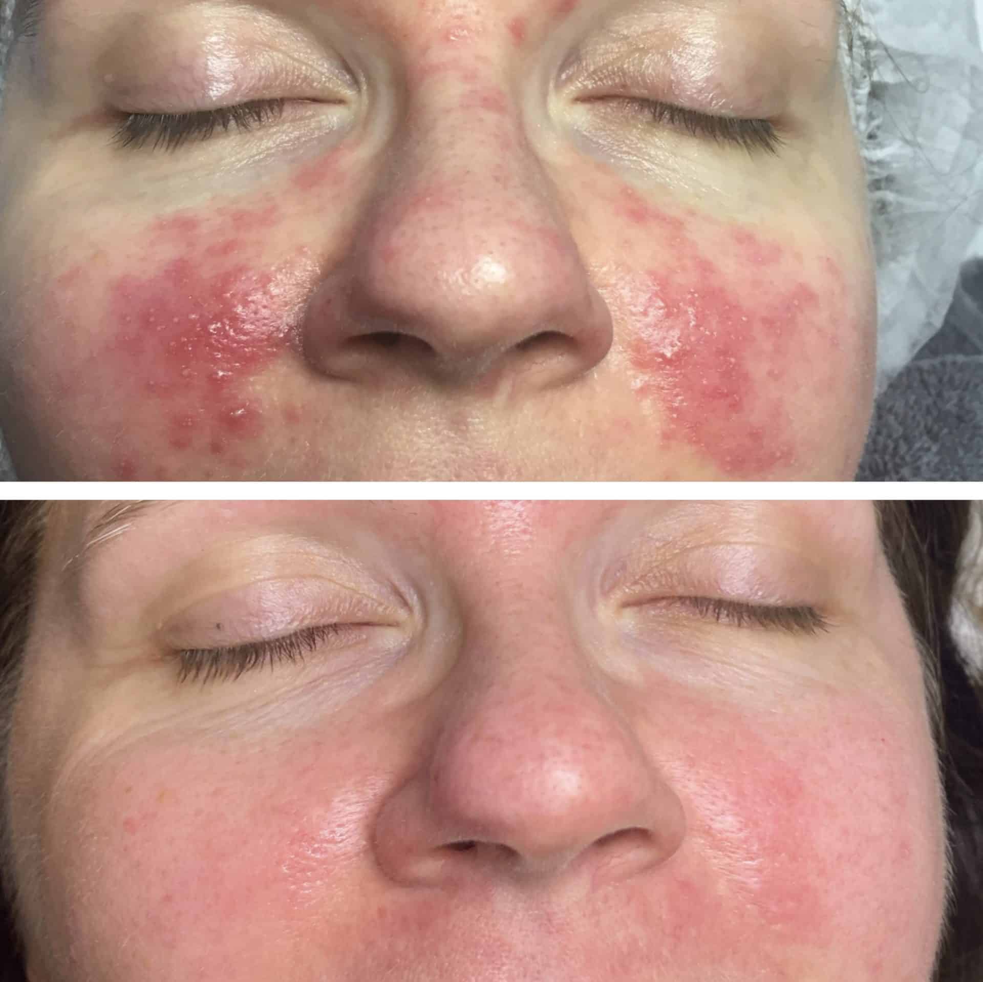 Behandling af Rosacea