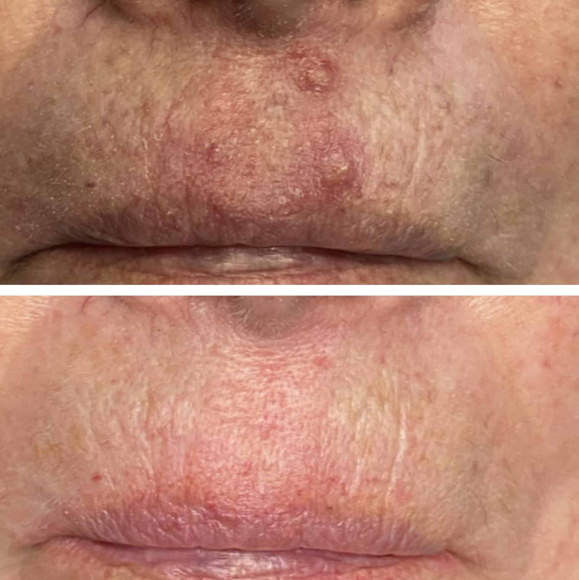 Behandling af Rosacea