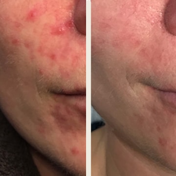 Behandling af Rosacea