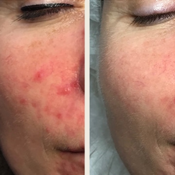 Behandling af Rosacea