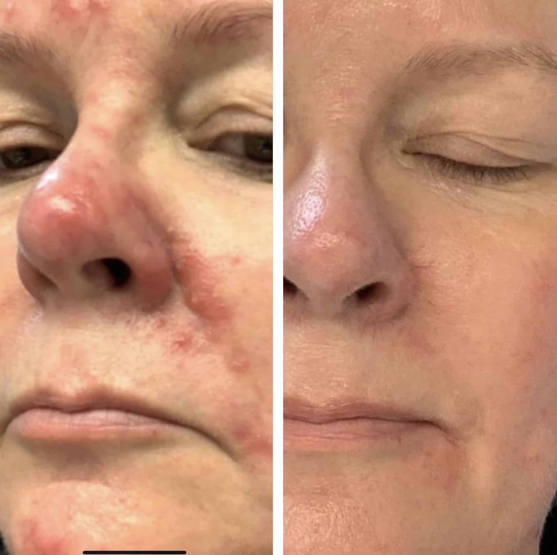 Behandling af Rosacea
