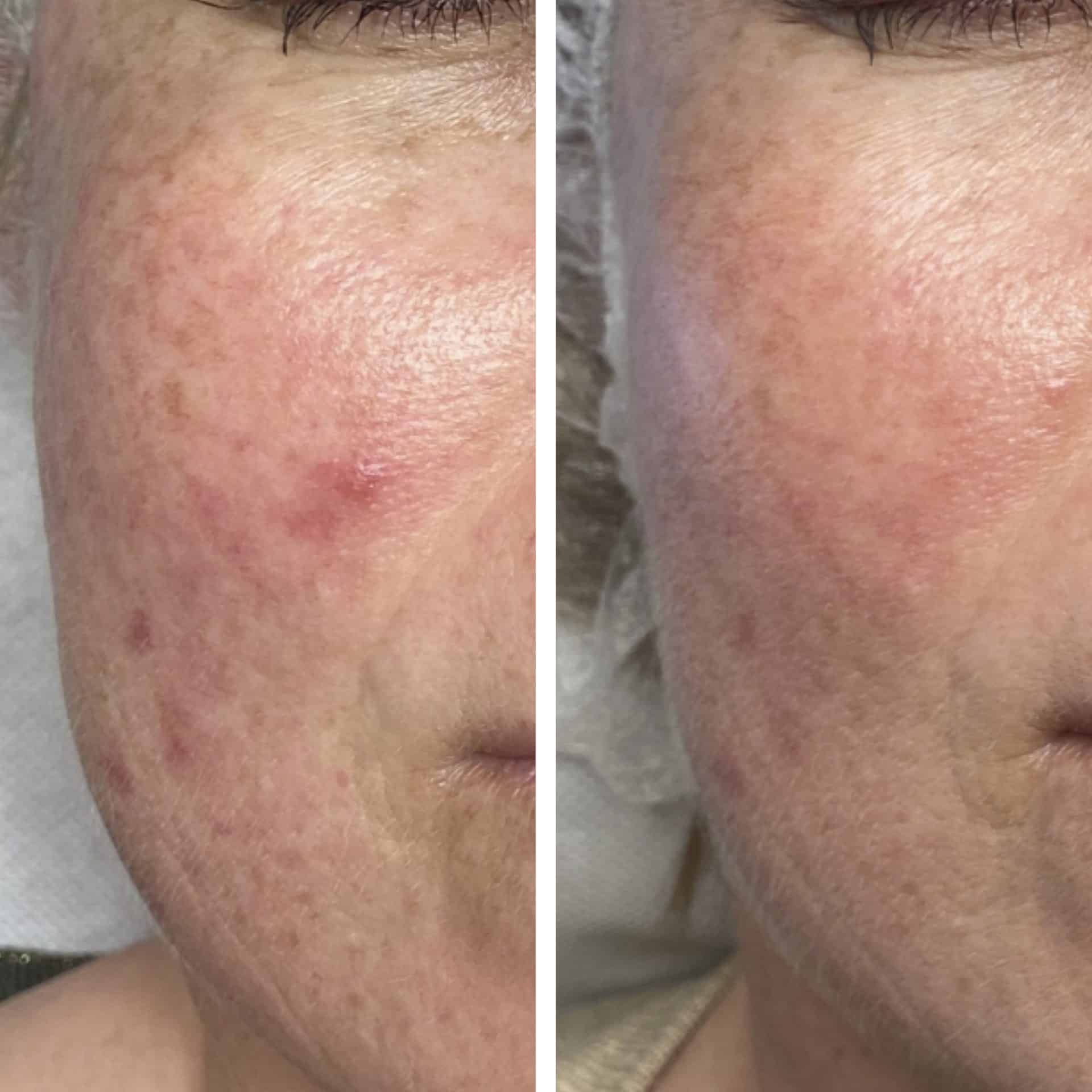 Behandling af Rosacea