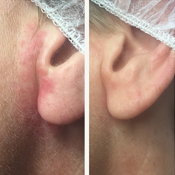 Perioral dermatitis - før & efter Behandlingsforløb