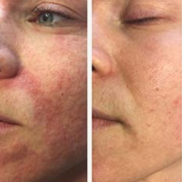 Behandling af Perioral dermatitis