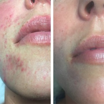 Behandling af Perioral dermatitis