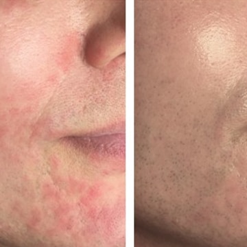 Behandling af Perioral dermatitis