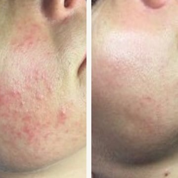 Behandling af Perioral dermatitis