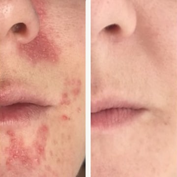 Behandling af Perioral dermatitis