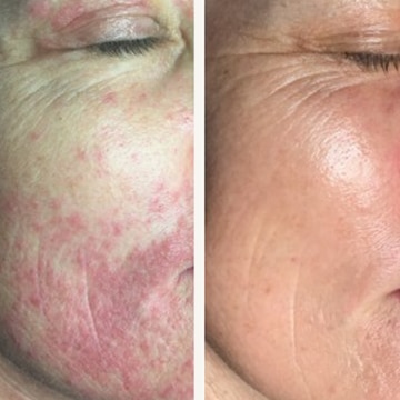 Behandling af Perioral dermatitis