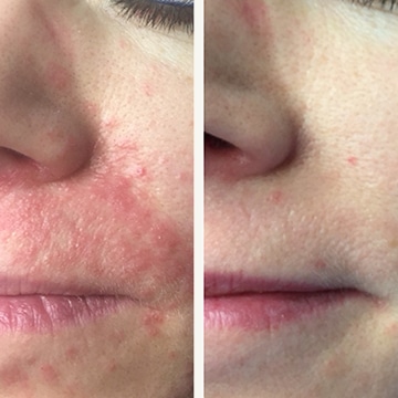 Perioral dermatitis - før & efter Behandlingsforløb