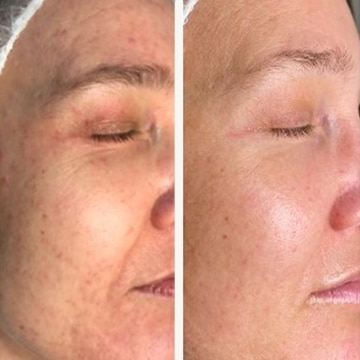 Behandling af Perioral dermatitis