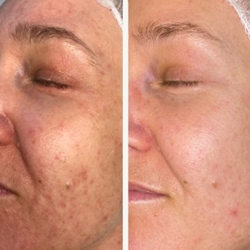 Behandling af Perioral dermatitis
