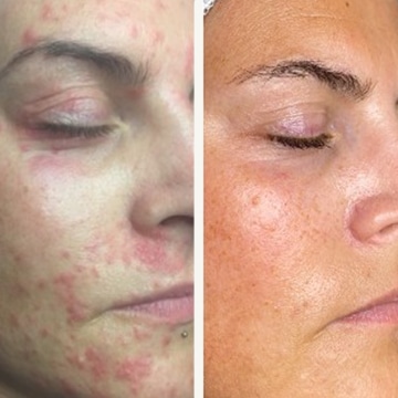 Behandling af Perioral dermatitis
