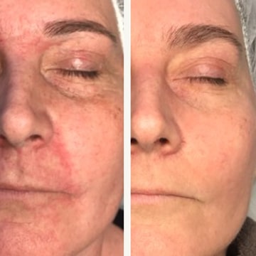 Behandling af Perioral dermatitis