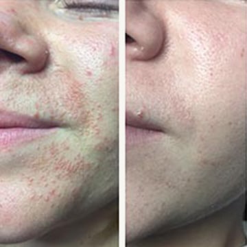 Behandling af Perioral dermatitis