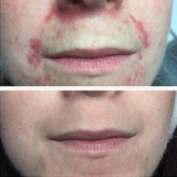 Behandling af Perioral dermatitis