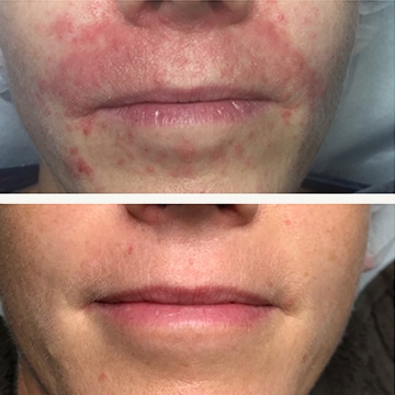 Behandling af Perioral dermatitis
