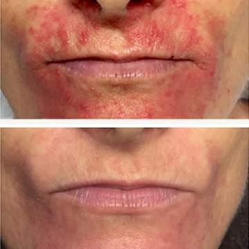 Behandling af Perioral dermatitis