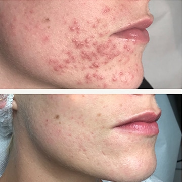 Behandling af Perioral dermatitis