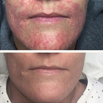 Behandling af Perioral dermatitis