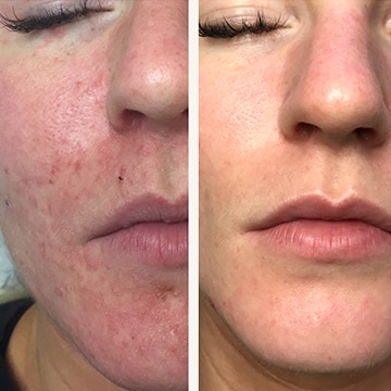 Perioral dermatitis - før & efter Behandlingsforløb