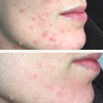Behandling af Perioral dermatitis