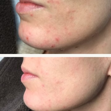 Behandling af Perioral dermatitis