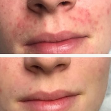 Behandling af Perioral dermatitis
