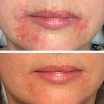 Behandling af Perioral dermatitis