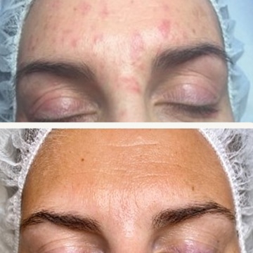 Behandling af Perioral dermatitis