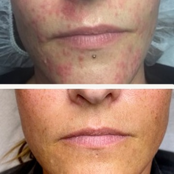 Behandling af Perioral dermatitis