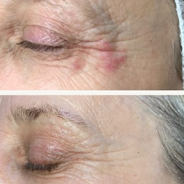 Behandling af Perioral dermatitis