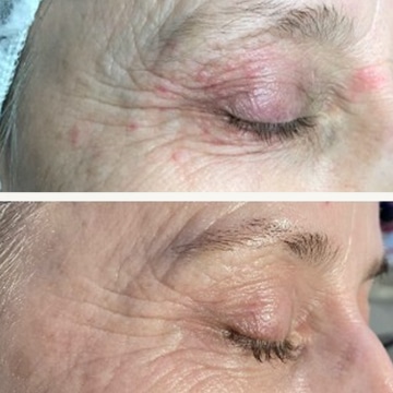 Behandling af Perioral dermatitis