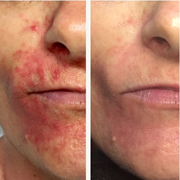 Perioral dermatitis - før & efter Behandlingsforløb