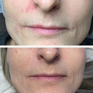 Behandling af Perioral dermatitis