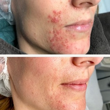 Behandling af Perioral dermatitis