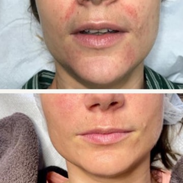 Behandling af Perioral dermatitis
