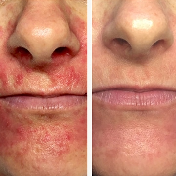 Perioral dermatitis - før & efter Behandlingsforløb
