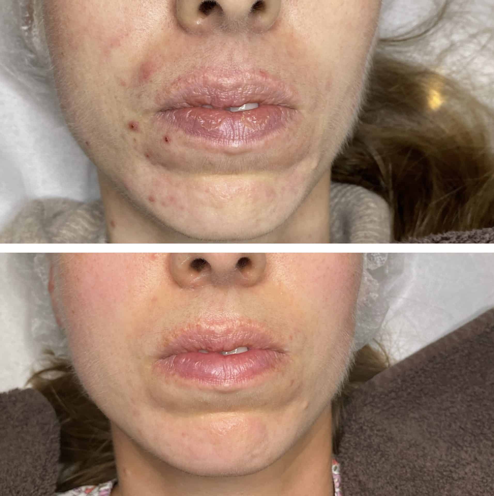 Behandling af Perioral dermatitis